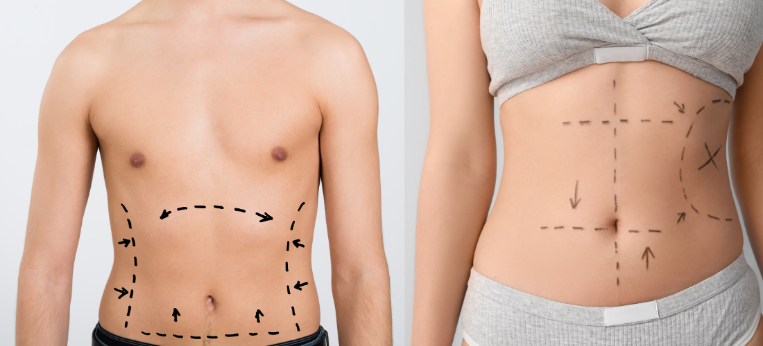 Liposuction Body Contouring